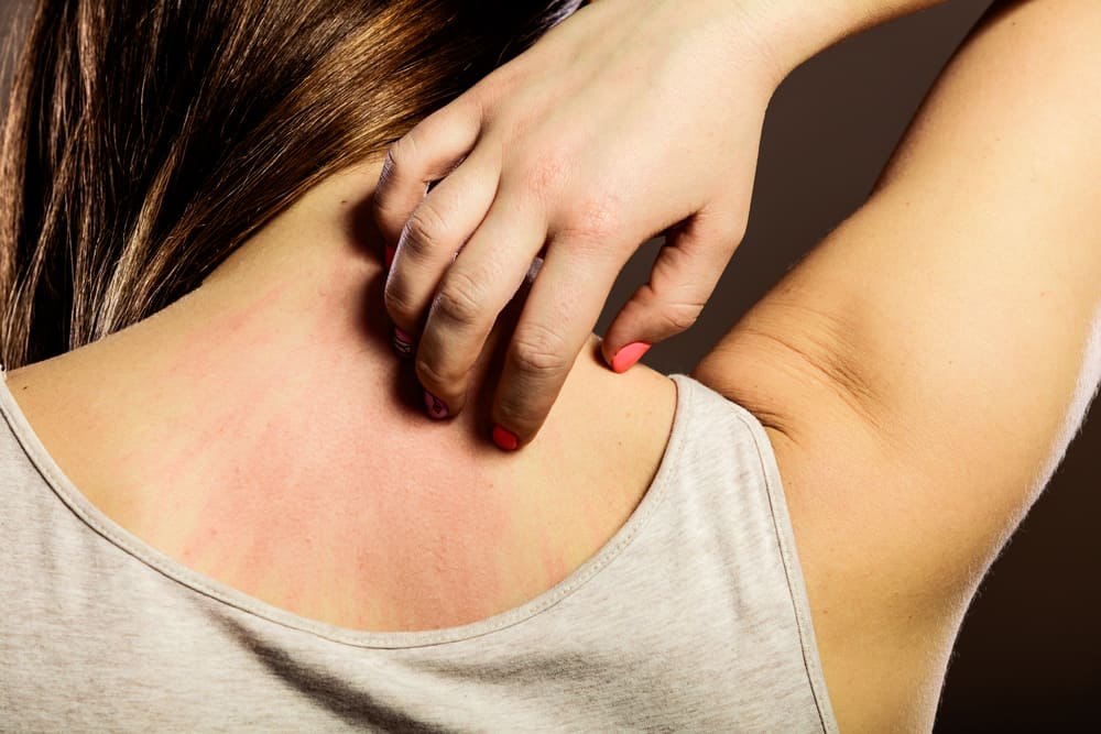 How to Get Rid of Hives - itchy