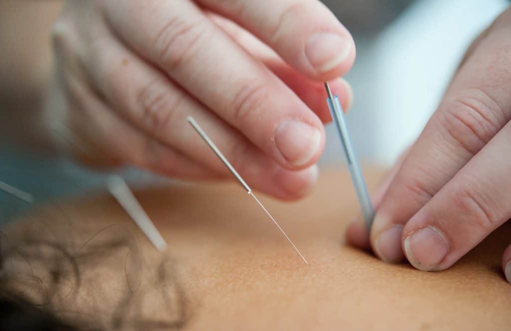 Membrane Sweep - acupuncture